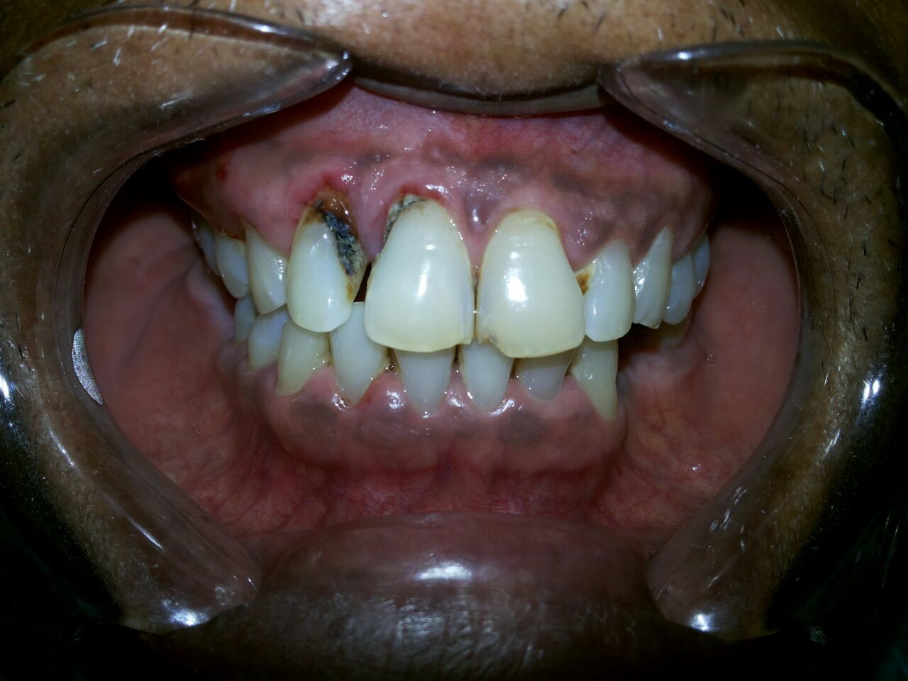 Mengapa gusi saya nampak&nbsp;kehitaman?